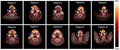 Salivary excretion of systemically injected [18F]DCFPyL in prostate cancer patients undergoing PSMA scans